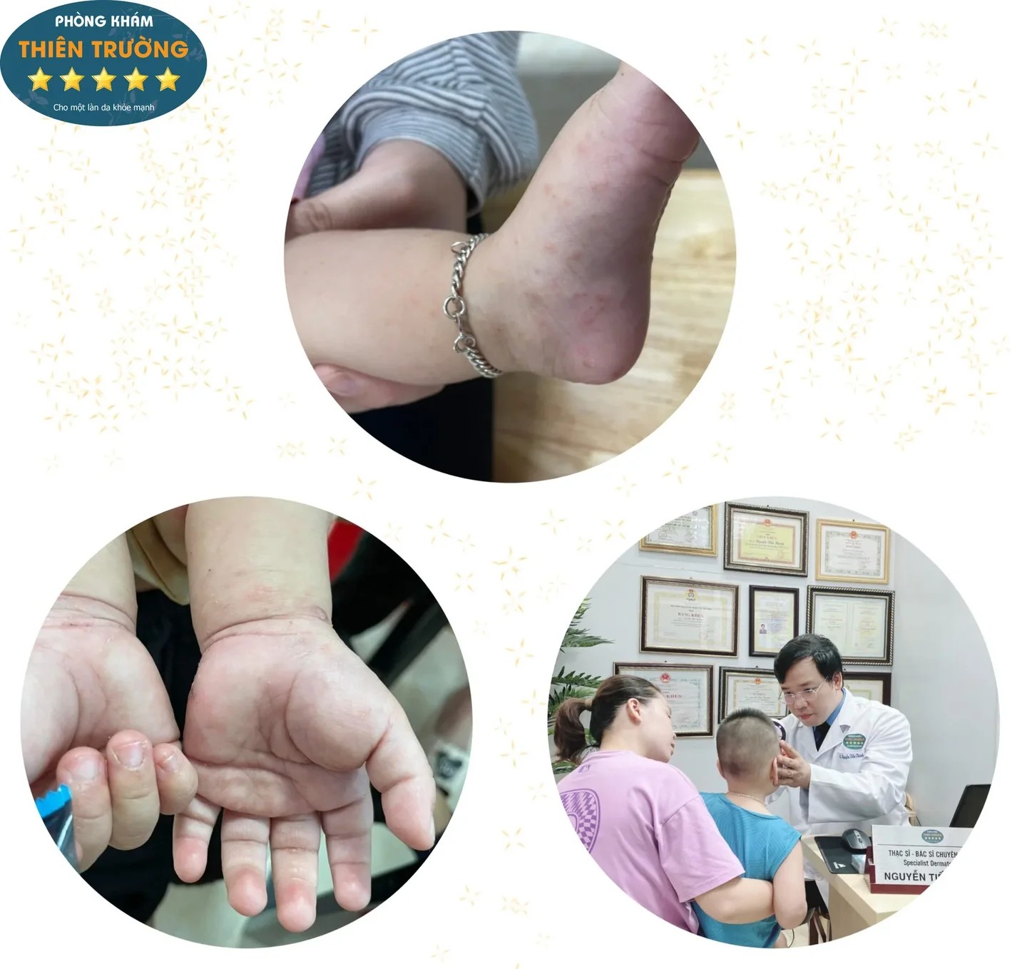 Hình ảnh: Bệnh ghẻ