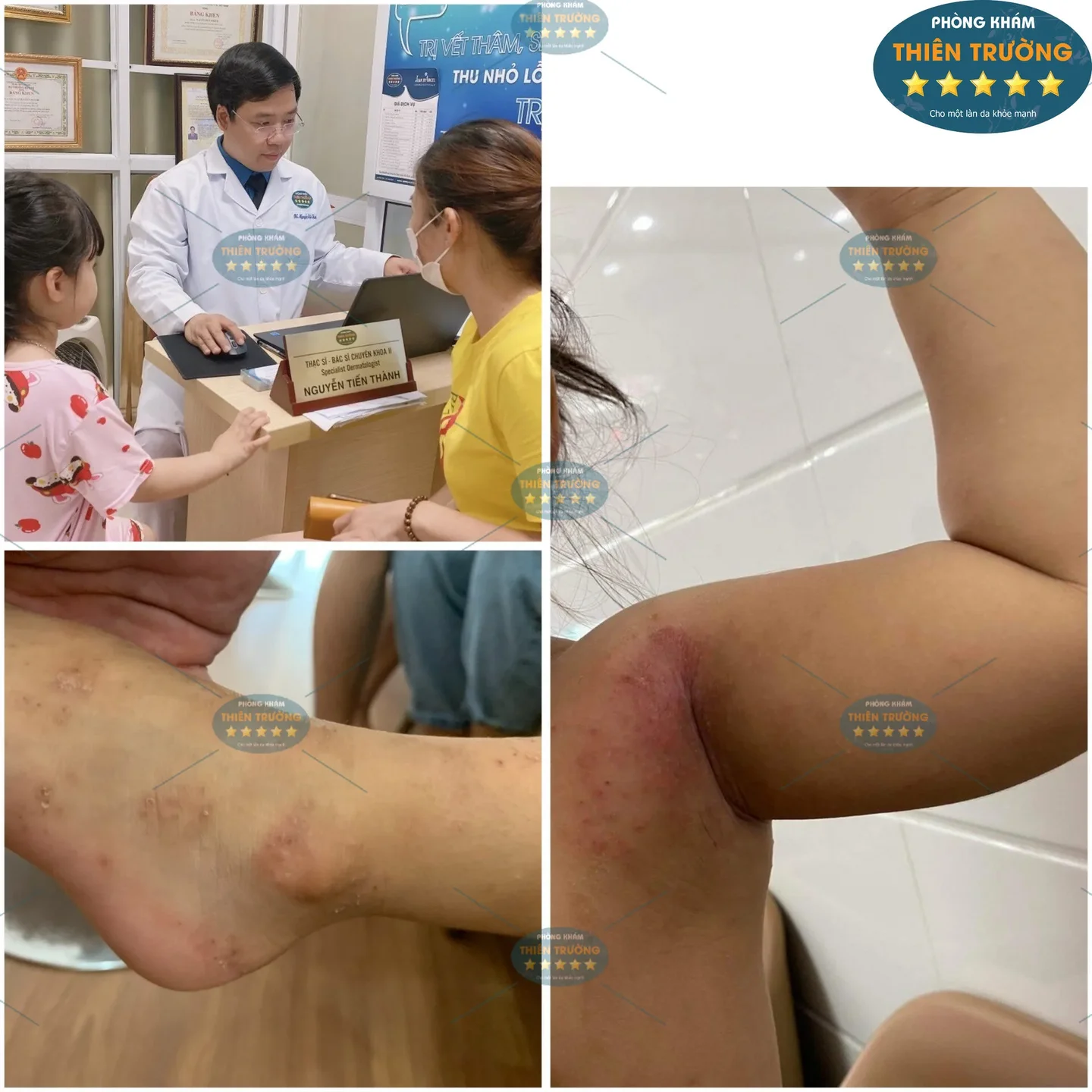 Hình ảnh: Bệnh ghẻ