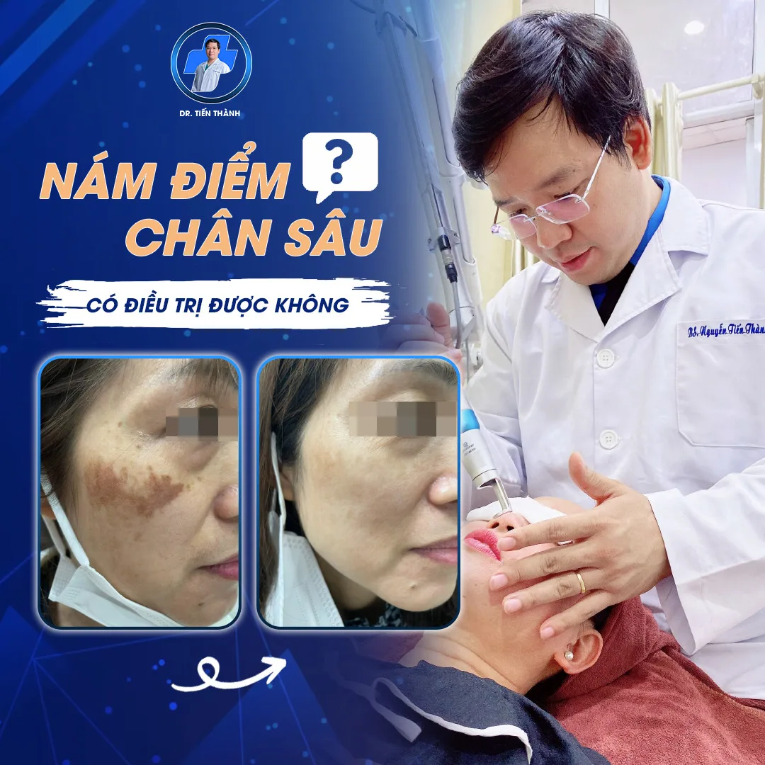 Hình ảnh: Trước và sau khi điều trị nám da