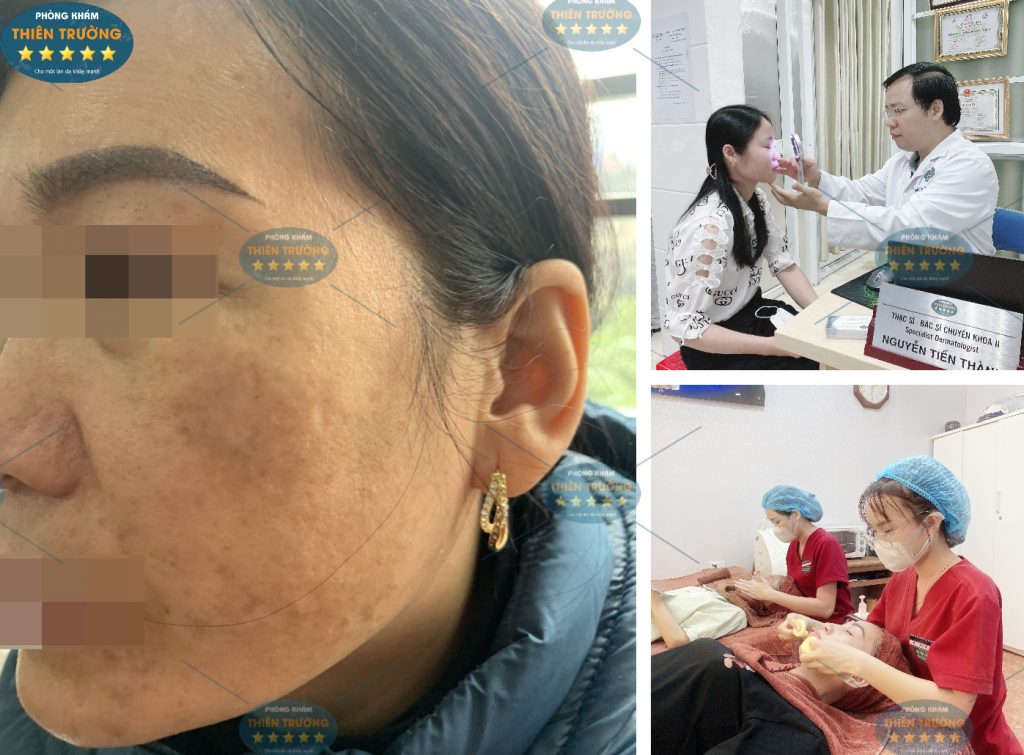 Hình ảnh: Nám da.