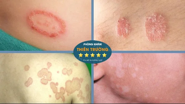 Hình ảnh: Khách hành bị nấm da tại phòng khám