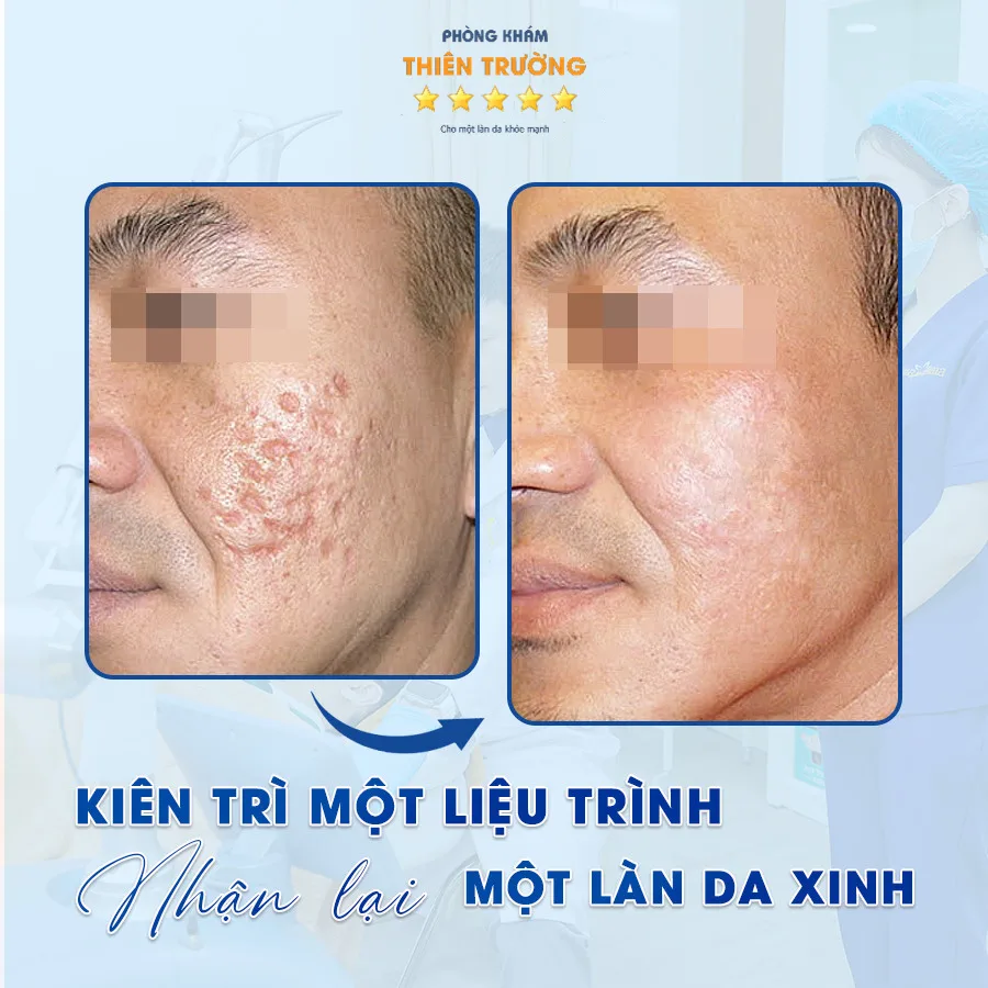 Hình ảnh: Trước và sau khi điều trị sẹo.