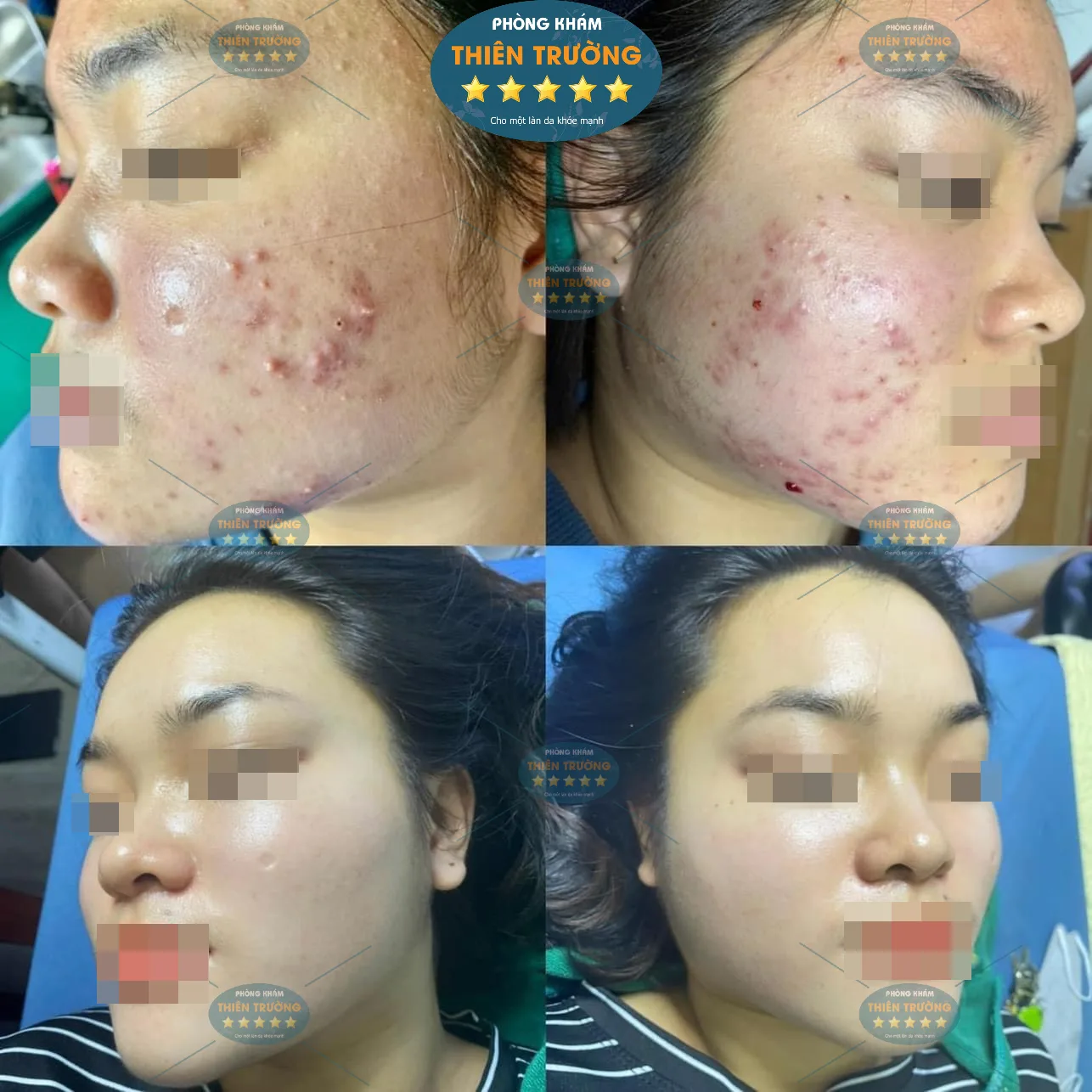 Hình ảnh: Trước sau khi trị mụn tại phòng khám Da liễu thẩm mỹ Thiên Trường.