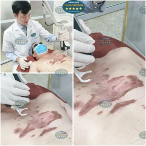Hình ảnh: bác sĩ Nguyễn Văn Hoàn đang điều trị sẹo lồi cho khách hàng