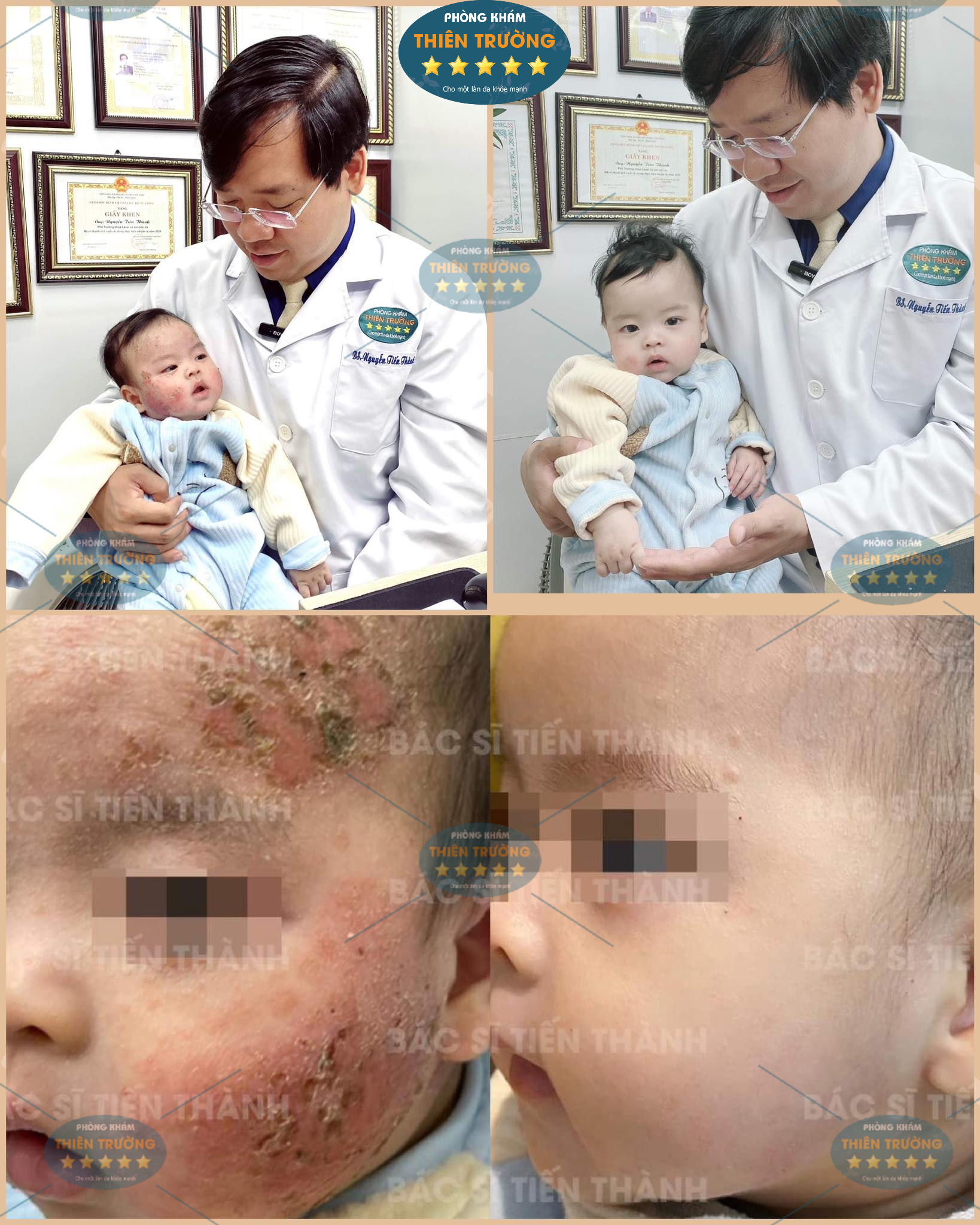 Hình ảnh: Thạc sĩ – Bác sĩ CKII Nguyễn Tiến Thành điều trị viêm da cơ địa cho em bé sau 1 tuần.