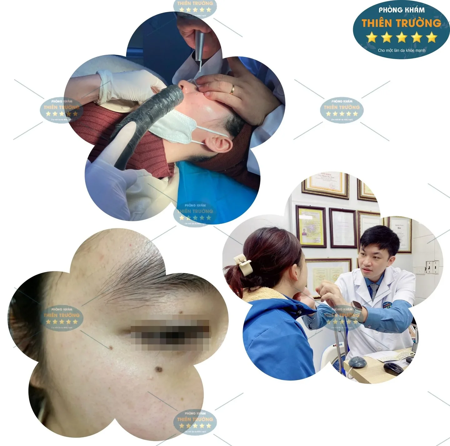 Hình ảnh: Khách hàng tẩy nốt ruồi tại phòng khám Da liễu thẩm mỹ Thiên Trường.