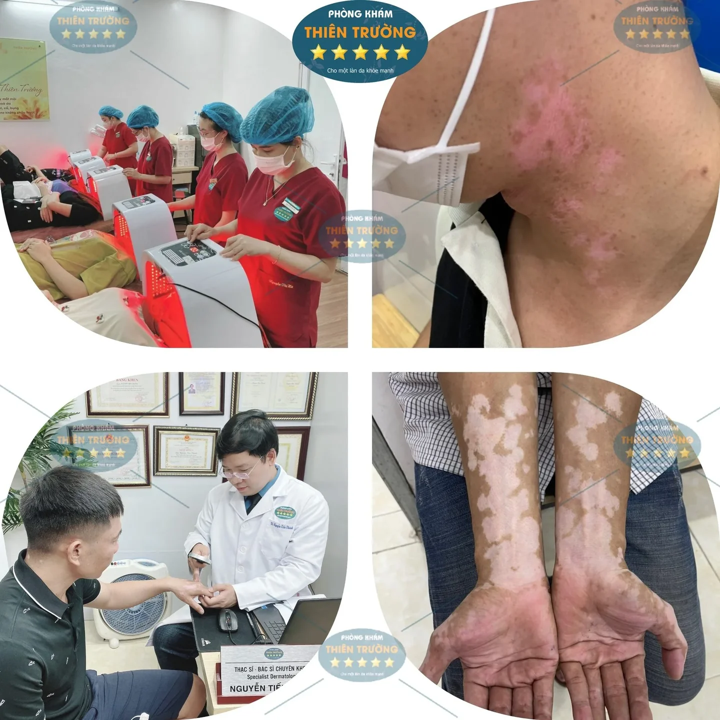 Hình ảnh: Khách hàng điều trị bạch biến tại phòng khám Da liễu thẩm mỹ Thiên Trường.