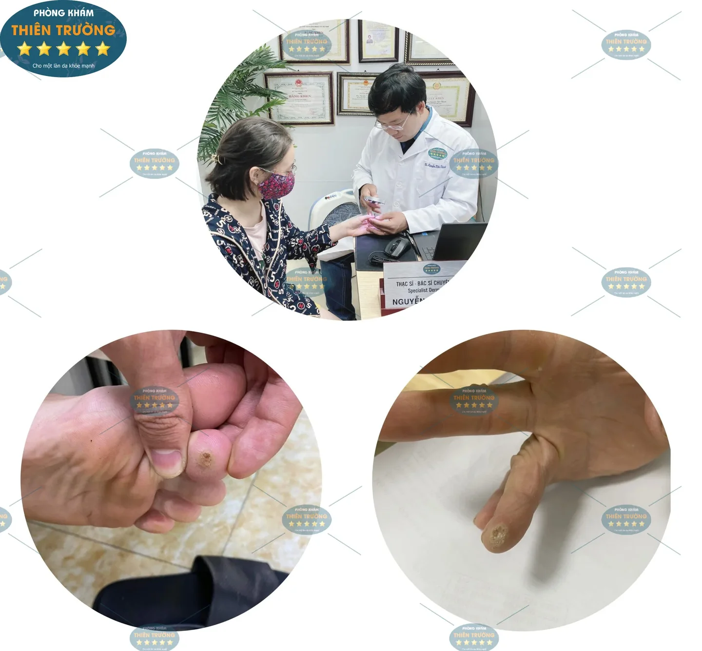 Hình ảnh: Thạc sĩ- Bác sĩ Nguyễn Tiến Thành CK II đang hỗ trợ điều trị hạt cơm cho bệnh nhân.