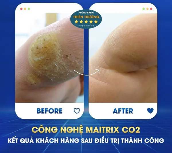 Hình ảnh: Khách hàng trước sau khi điều trị hạt cơm tại phòng khám Da liễu thẩm mỹ Thiên Trường.