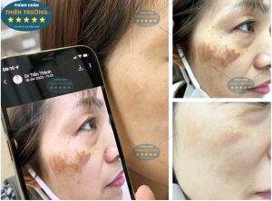 Hình ảnh: Trước và sau khi khách hàng điều trị tại phòng khám da liễu thẩm mỹ Thiên Trường.