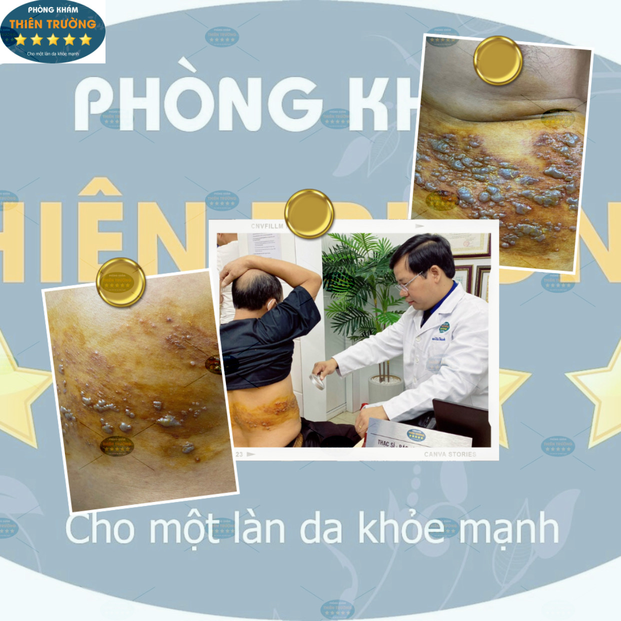 Hình ảnh: Thạc sĩ- Bác sĩ CK II Nguyễn Tiến Thành đang khám cho bệnh nhân zona thần kinh.