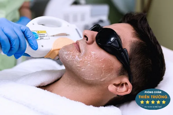 Hình ảnh: Triệt lông râu.