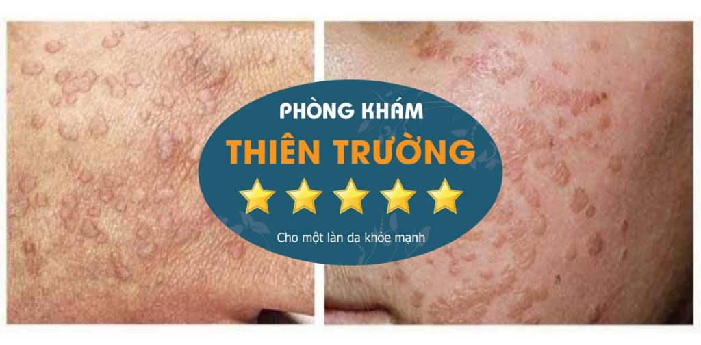 Hình ảnh : hạt cóc phẳng
