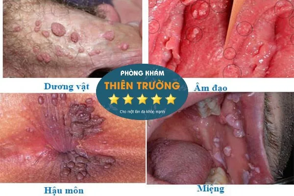 Hình ảnh : sùi mào gà