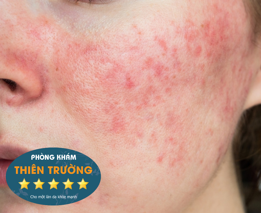 Hình ảnh: Mụn trứng cá đỏ.