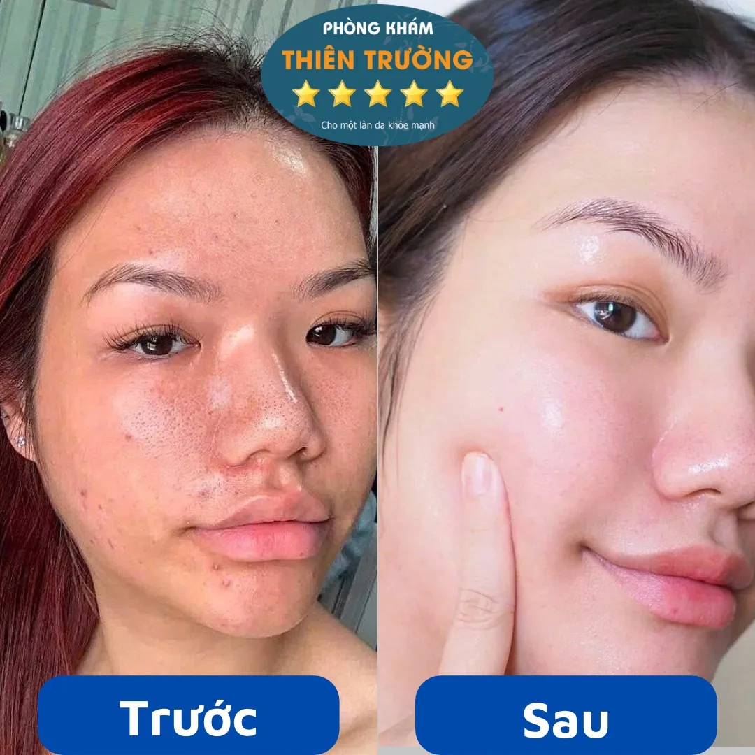Hình ảnh : Bệnh nhân trước và sau điều trị.