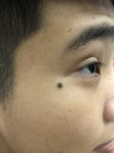 Hình ảnh: Nốt ruồi.