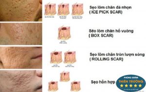 Hình ảnh : Các loại sẹo lõm