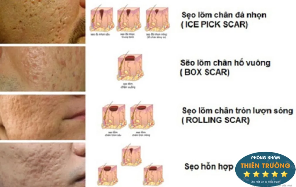Hình ảnh : Các loại sẹo lõm