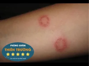 Hình ảnh: bệnh hắc lào