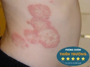 Hình ảnh: bệnh hắc lào