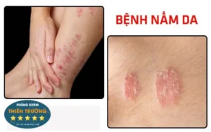 Hình ảnh: nấm da