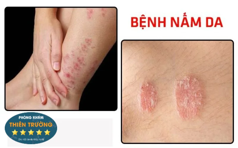 Hình ảnh: Nấm da