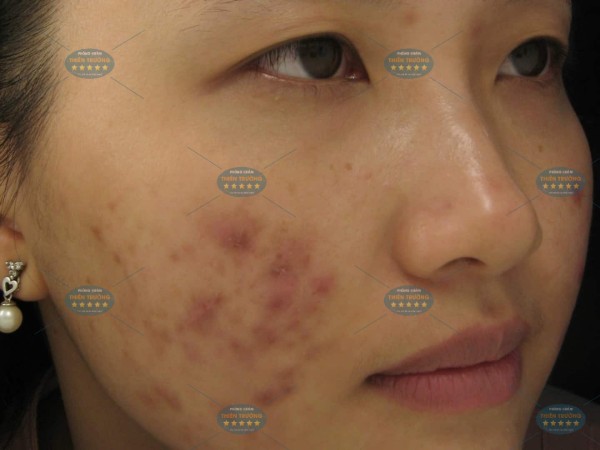 Hình ảnh : Sẹo thâm do mụn.