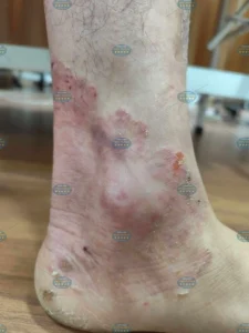 Hình ảnh : Nấm da chân