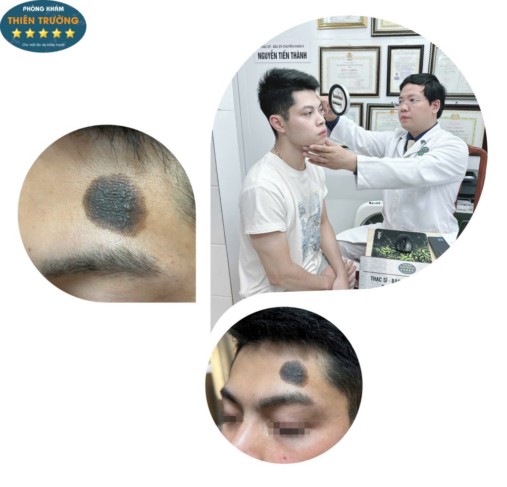 Hình ảnh: Bệnh nhân được thăm khám điều trị bớt sắc tố.