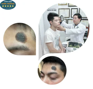 Hình ảnh: Bệnh nhân được thăm khám điều trị bớt sắc tố.