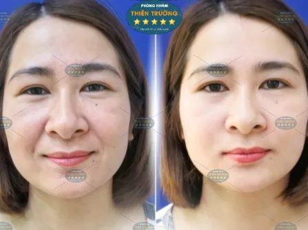 Hình ảnh: Khách hàng trước và sau khi điều trị.