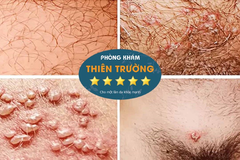 Hình ảnh: Herpes sinh dục.