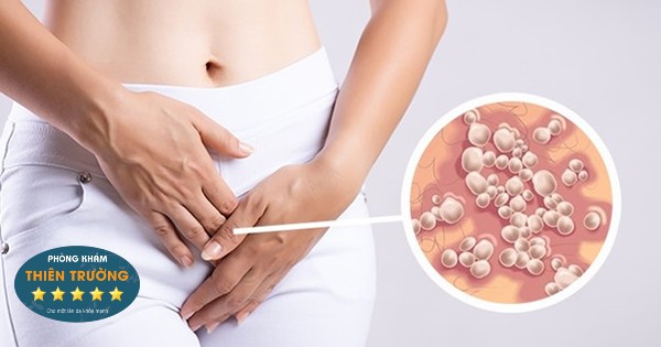 Hình ảnh: Herpes sinh dục.