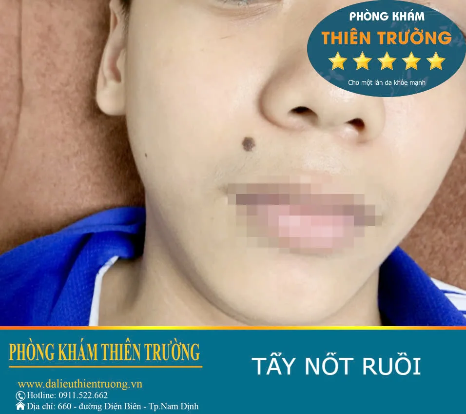 Hình ảnh: Nốt ruồi.