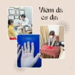Hình ảnh: Viêm da cơ địa.