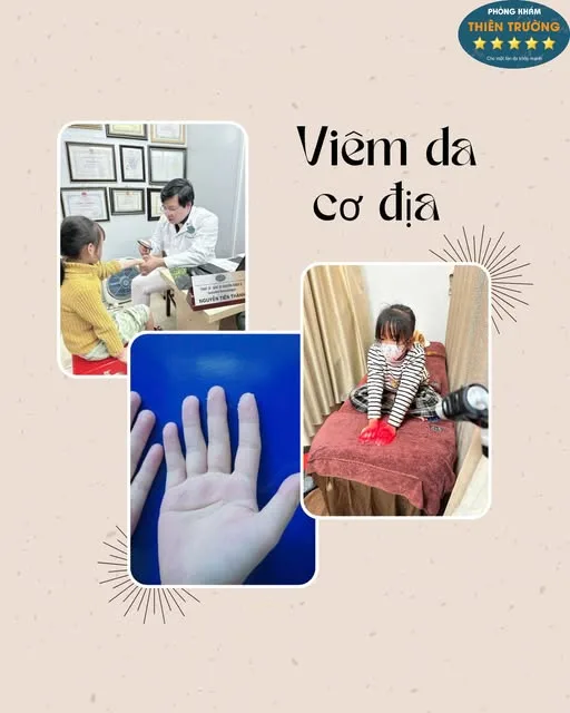 Hình ảnh: Viêm da cơ địa.