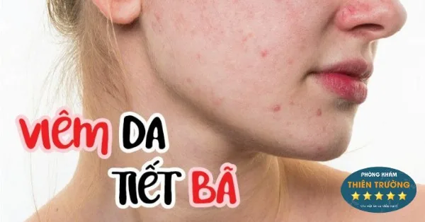 5fa6c1019ad1b458cc6c8af2_viem-da-tiet-ba-764x400