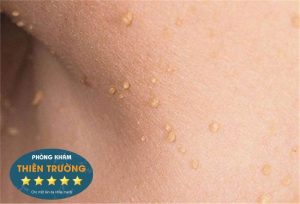 Hình ảnh: Mụn thịt ở cổ.