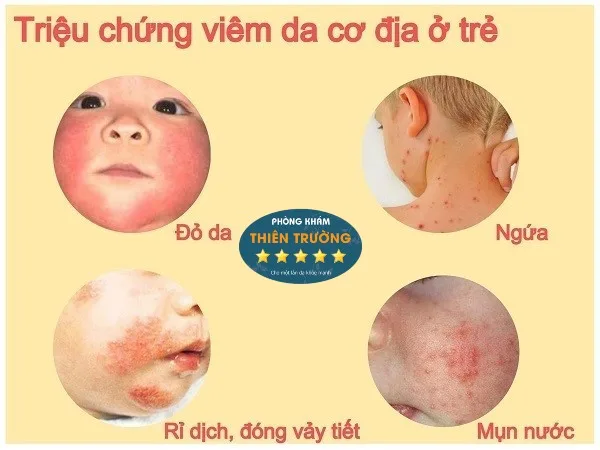 Hình ảnh : Triệu chứng viêm da cơ địa ở trẻ nhỏ.
