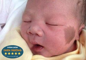 Hình ảnh: Bớt sắc tố ở trẻ nhỏ.