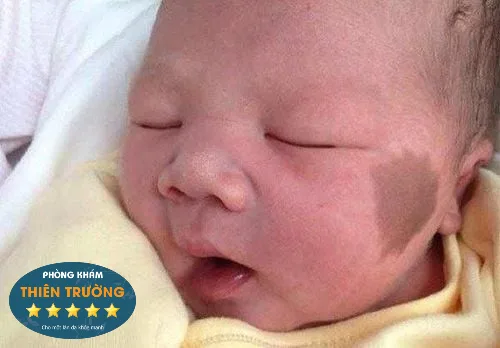 Hình ảnh: Bớt sắc tố ở trẻ nhỏ.