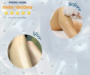 Hình ảnh: Khách hàng qua Phòng khám Da liễu Thẩm mỹ Thiên Trường triệt lông