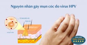 Hình ảnh: Nguyên Nhân gây mụn cóc.