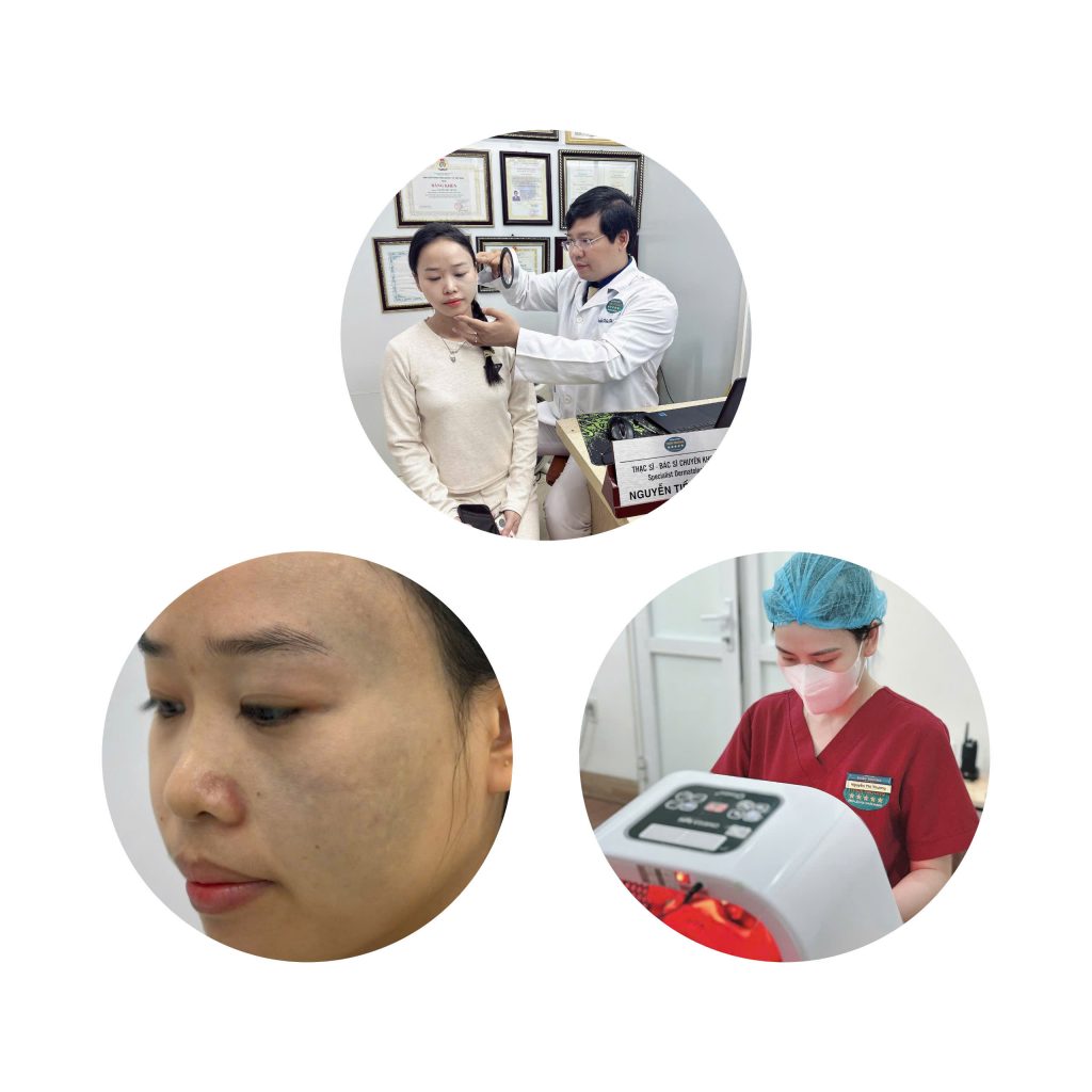 Hình ảnh : Bớt ota.