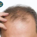 Hình ảnh: Rụng tóc ở nam giới.