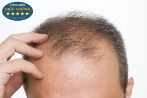 Hình ảnh: Rụng tóc ở nam giới.
