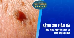 Hình ảnh: Biểu hiện sùi mào gà