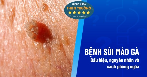 Hình ảnh: Biểu hiện sùi mào gà