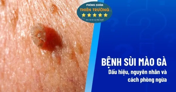 Hình ảnh: Biểu hiện sùi mào gà